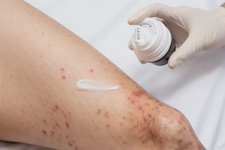 男性大腿容易长湿疹可以治好吗(图3)