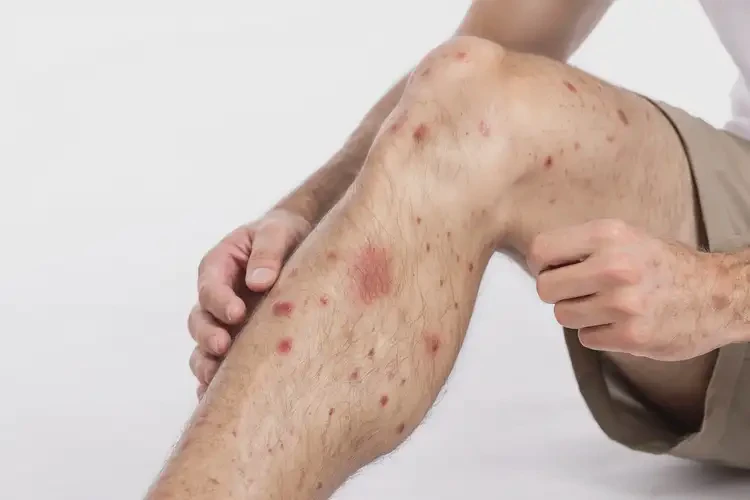 青年人大腿上偶尔起湿疹可以治好吗(图4)