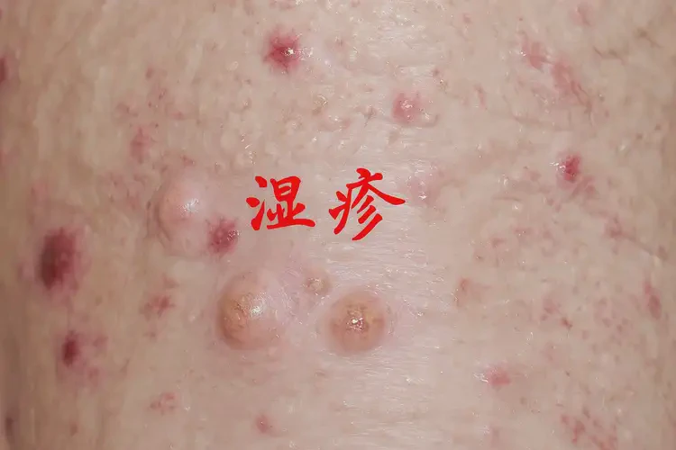 男生肛周容易起湿疹可以治好吗(图4)