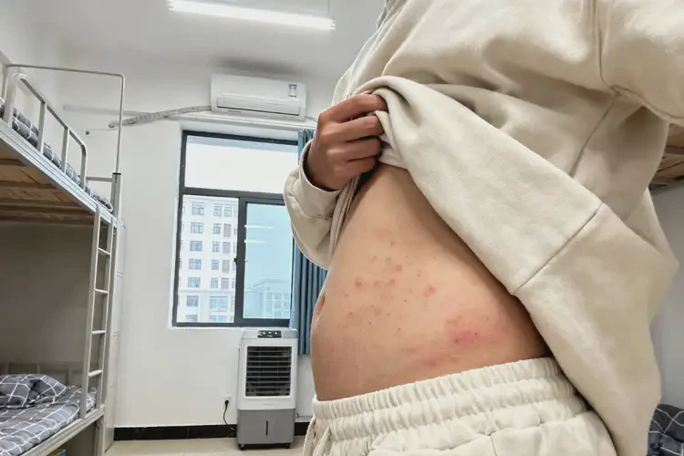 大学生肚子有湿疹能彻底自愈吗(图4)