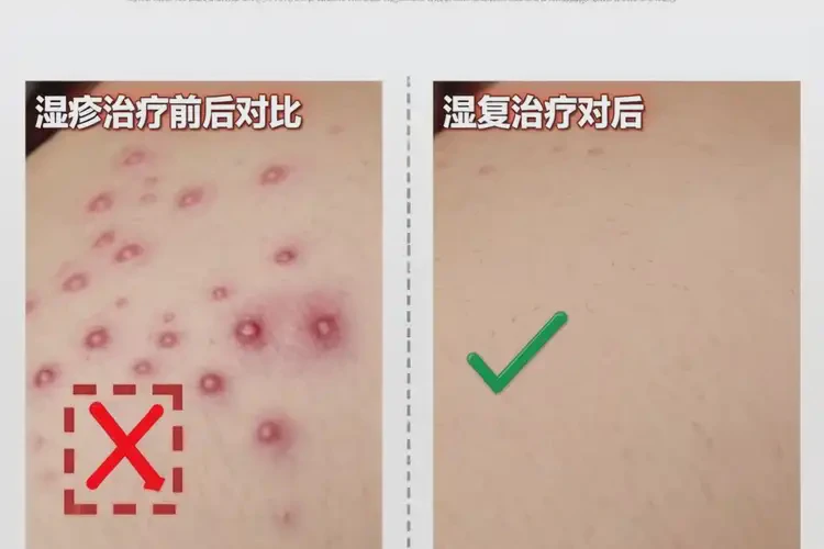 男性全身出现湿疹可以治好吗(图4)