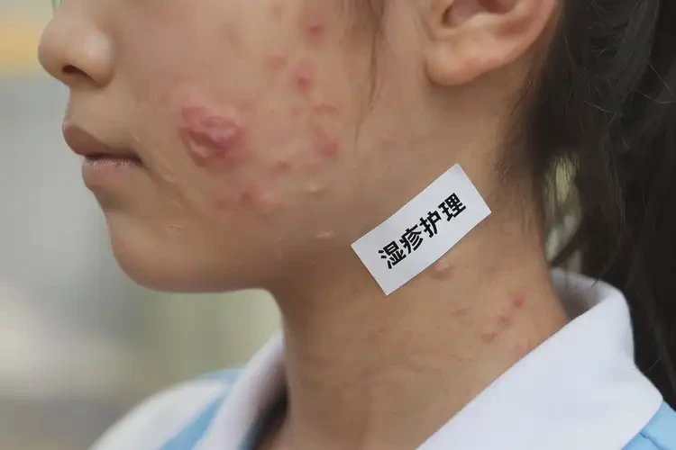 中学生脖子上长湿疹可以治好吗(图4)