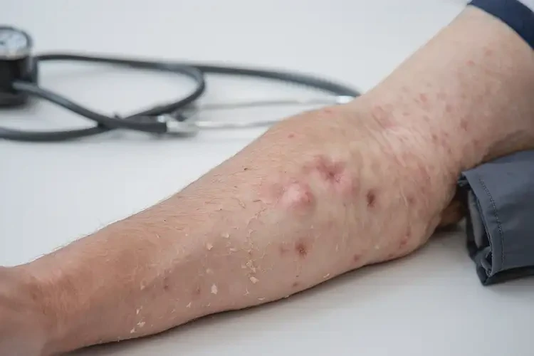 老人手臂上出湿疹可以治好吗(图3)