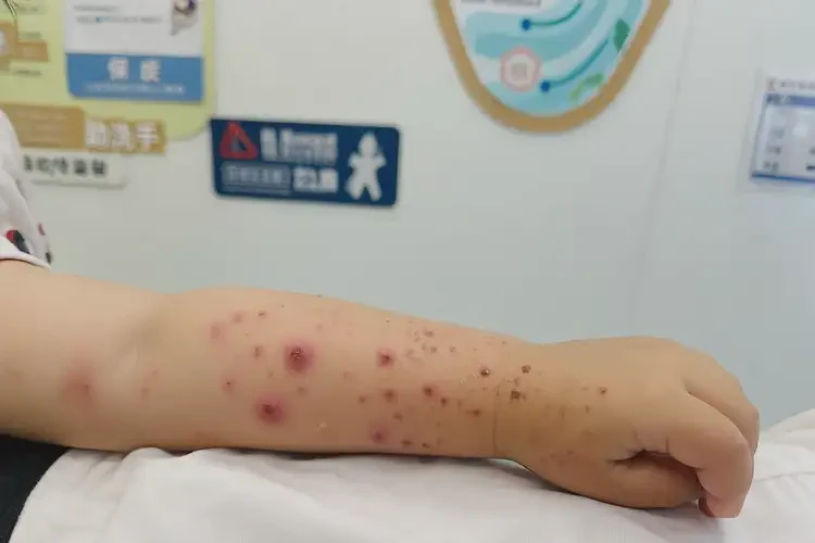 孩子手臂容易长湿疹可以治好吗(图4)