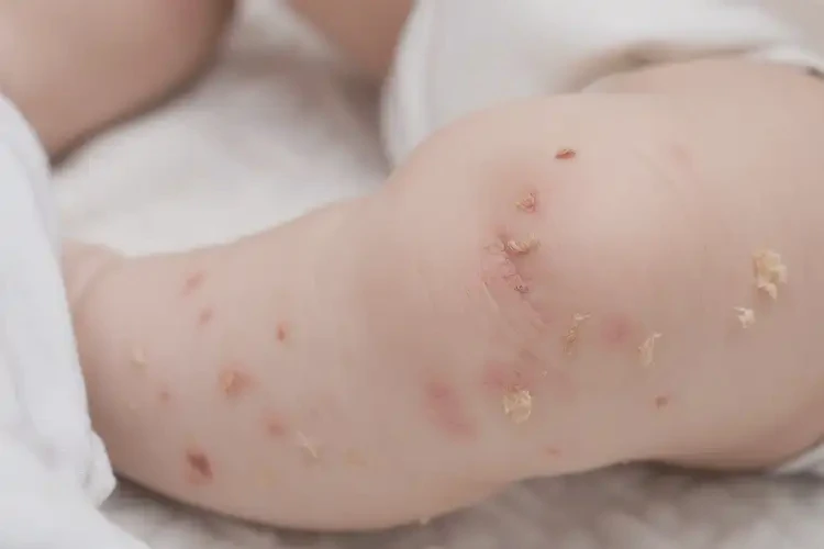 小孩小腿上起湿疹不管它会自己好吗(图4)