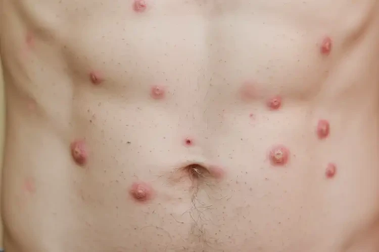 男生肚子偶尔长湿疹可以治好吗(图4)