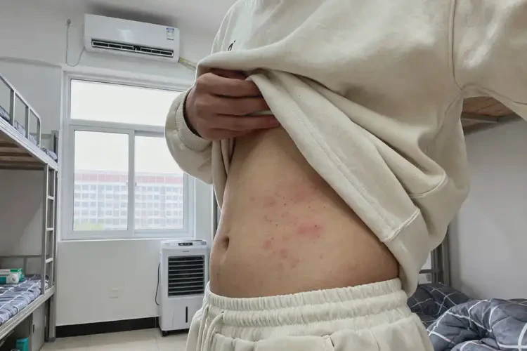 大学生肚子有湿疹能彻底自愈吗(图2)
