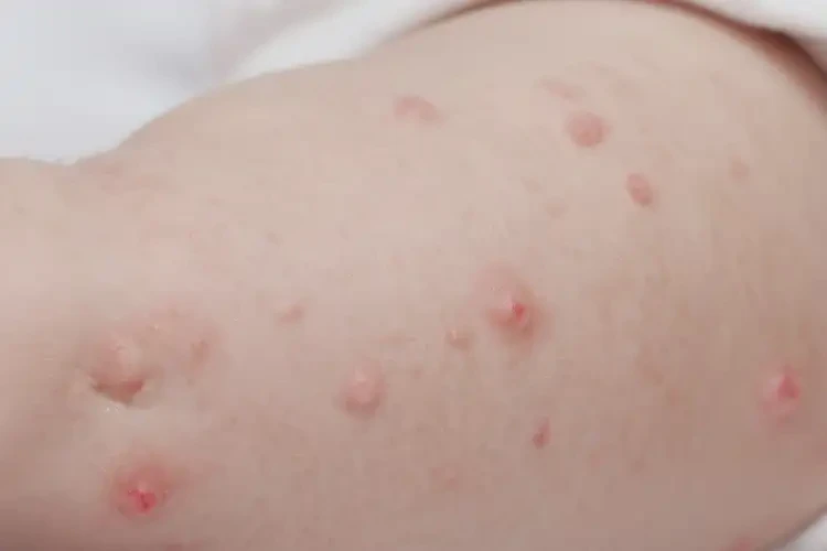 婴儿大腿上出湿疹可以治好吗(图4)