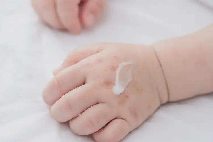 婴儿手上出现湿疹可以治好吗(图3)