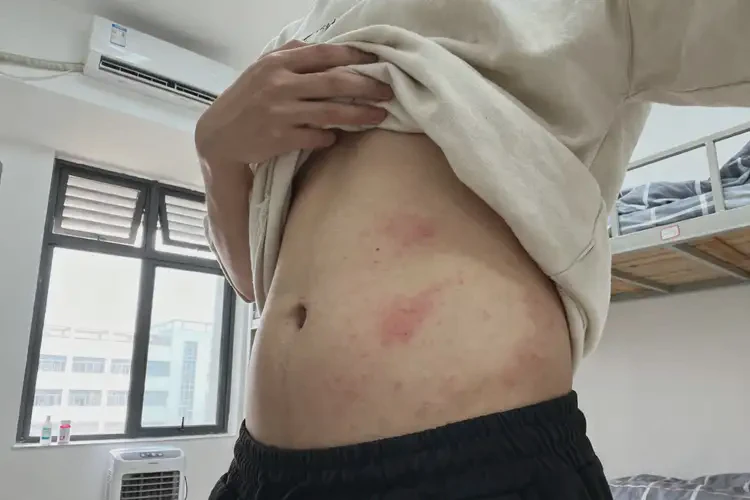 大学生肚子有湿疹能彻底自愈吗(图1)