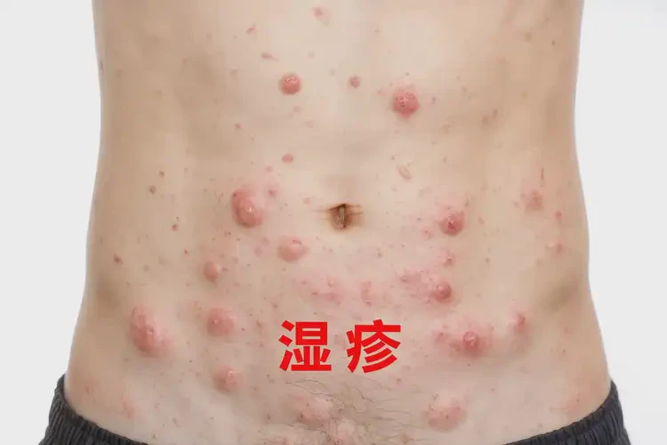 青年人肚子上偶尔长湿疹可以治好吗(图4)