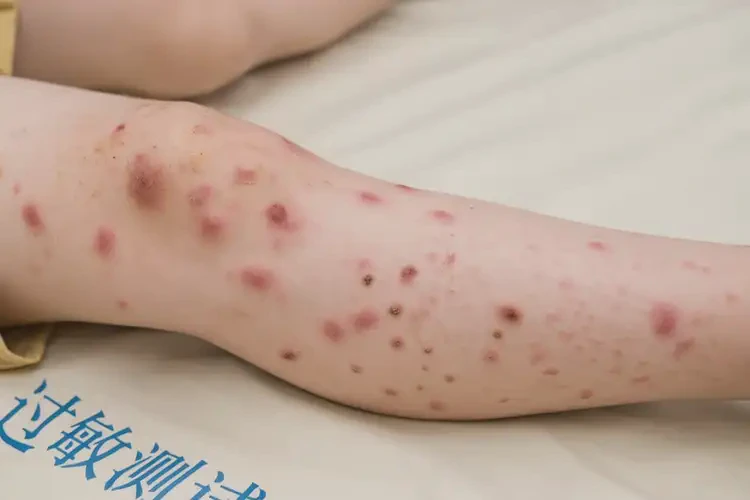 小孩小腿上起湿疹不管它会自己好吗(图3)