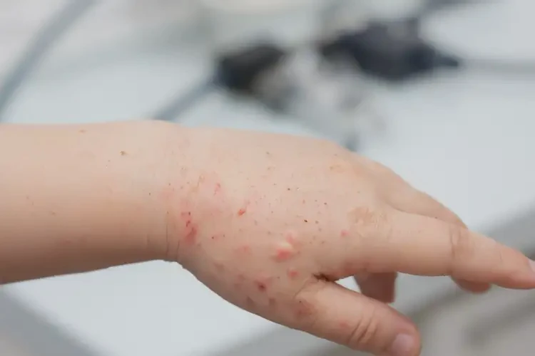 儿童手上长湿疹可以治好吗(图4)