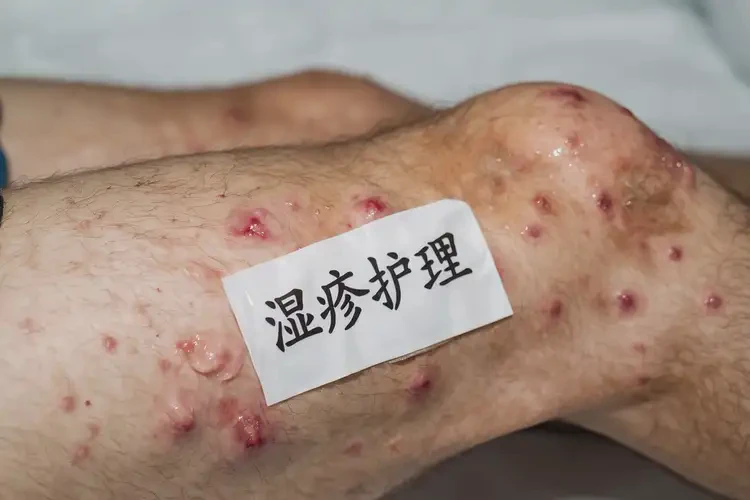 男性大腿容易长湿疹可以治好吗(图4)