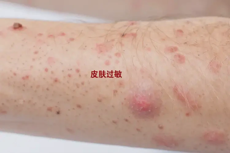男性手臂容易起湿疹可以治好吗(图4)