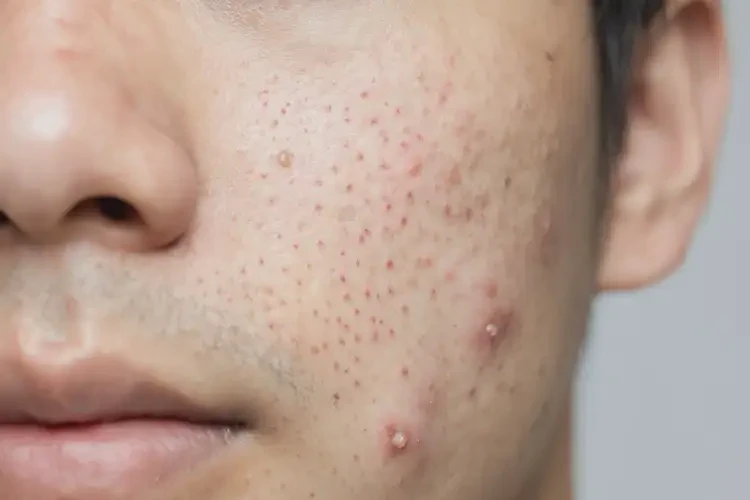 男生脸上长湿疹可以治好吗(图4)