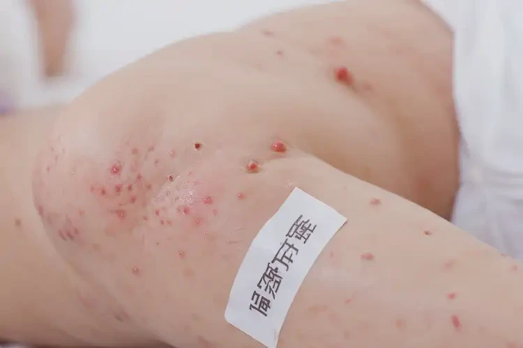 婴儿大腿经常长湿疹可以治好吗(图4)