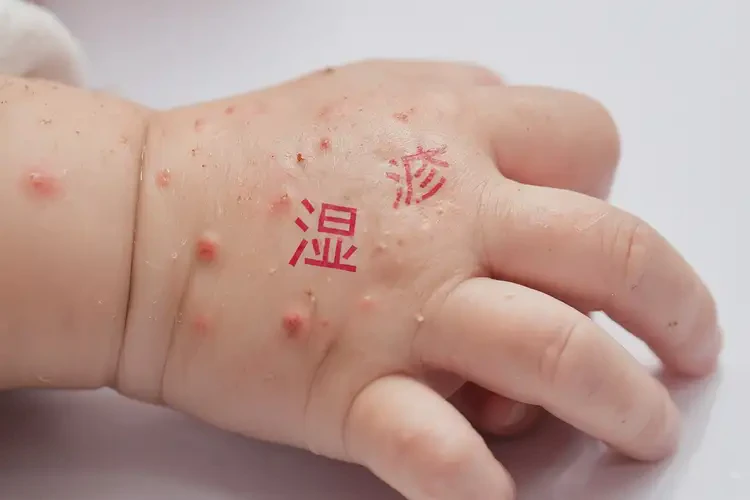 孩子手上有湿疹可以治好吗(图4)