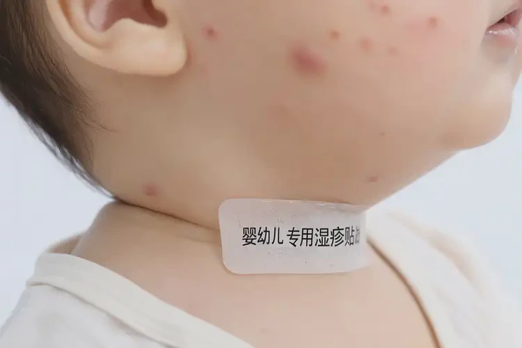 小孩脖子偶尔起湿疹能彻底自愈吗(图4)
