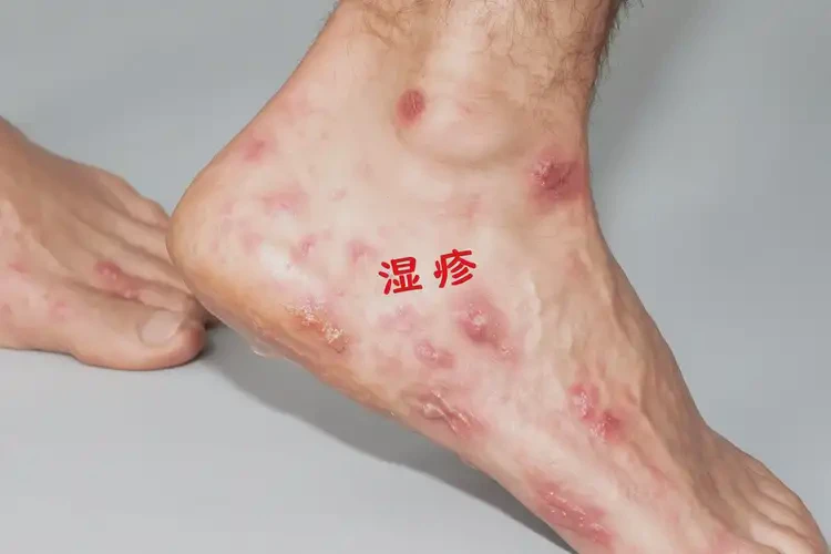 青年人脚上偶尔起湿疹可不可以根治(图4)