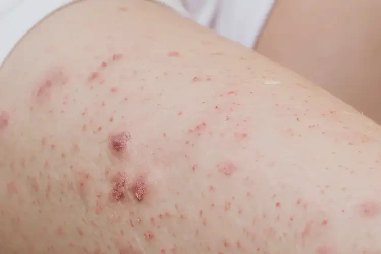 产妇屁股上起湿疹可以彻底自愈吗(图4)