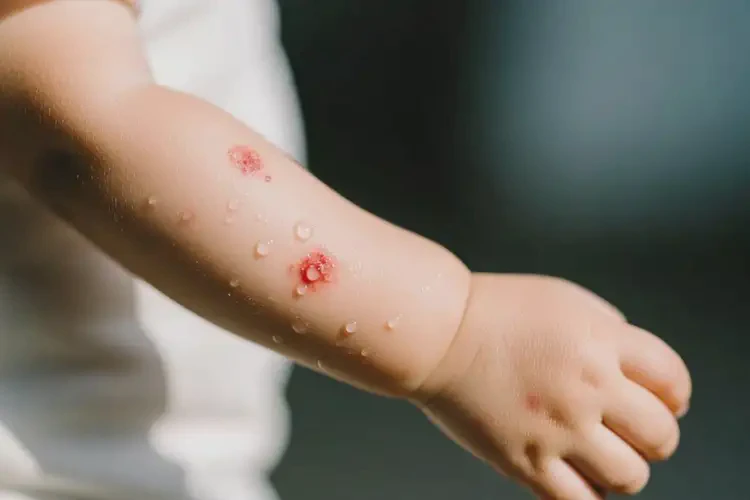 小孩手臂上偶尔起湿疹可以治好吗(图2)