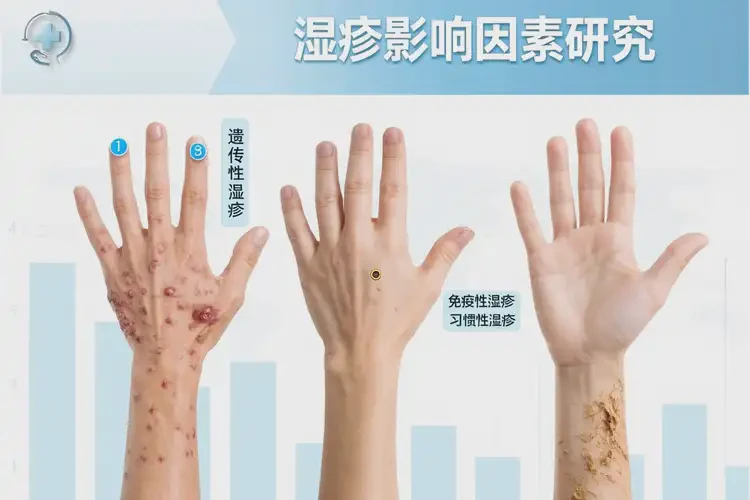 青年人手上偶尔起湿疹可不可以根治(图3)