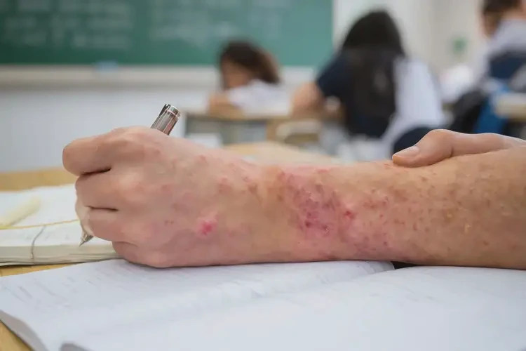 中学生手上偶尔起湿疹可不可以根治(图4)