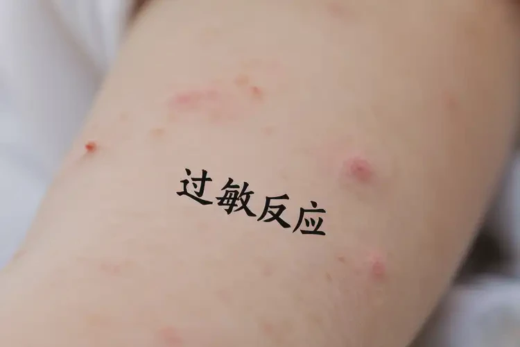 孩子屁股上出现湿疹可以治好吗(图4)