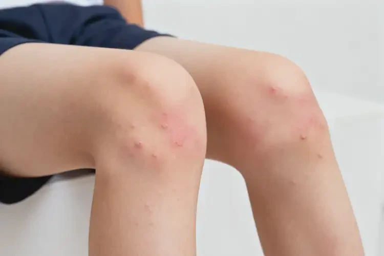 青少年大腿上出现湿疹可以彻底自愈吗(图4)