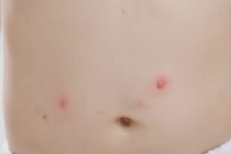 小孩肚子上长湿疹可以治好吗(图4)