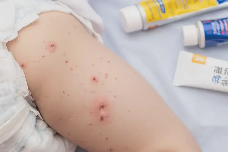 小孩屁股上有湿疹可以治好吗(图4)