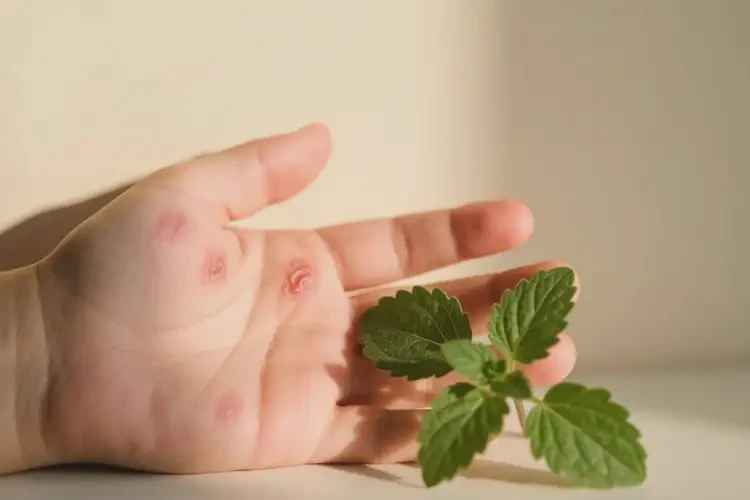 小儿手上出现湿疹可以治好吗(图4)