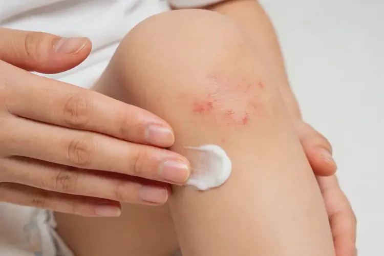 儿童大腿出湿疹可以治好吗(图2)