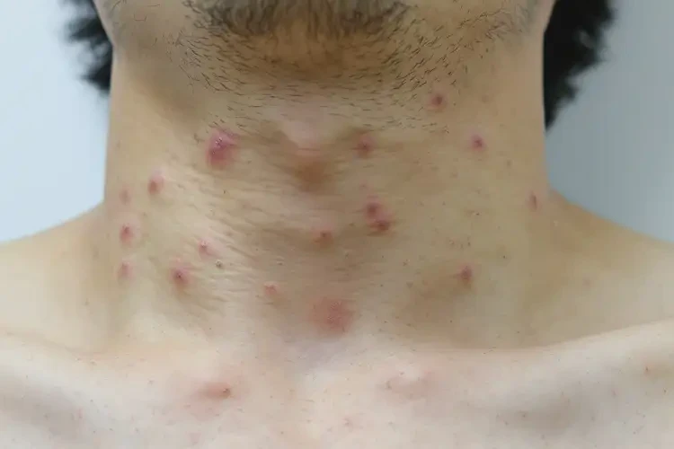 青年人脖子经常起湿疹可以彻底自愈吗(图4)