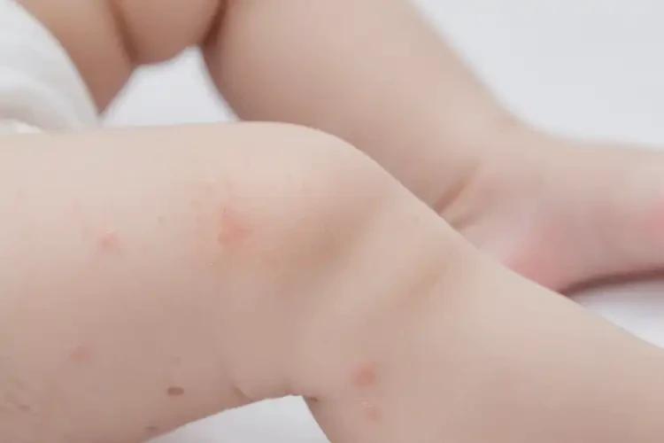婴幼儿小腿出现湿疹可以治好吗(图4)