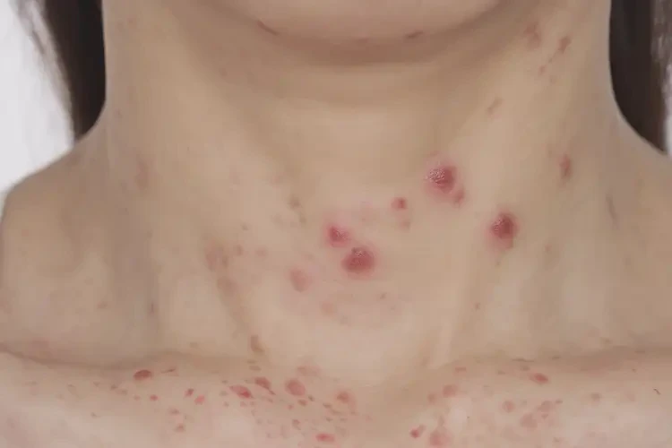 女生脖子上出湿疹可以治好吗(图4)