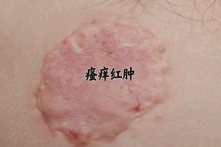 女生肛周长湿疹可以治好吗(图4)