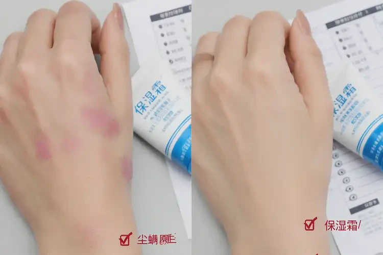 女性手上容易起湿疹可以治好吗(图4)