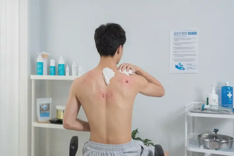 青年人屁股出湿疹可以治好吗(图2)