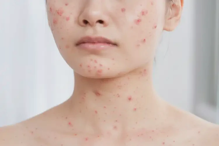 女性脖子上长湿疹可以治好吗(图4)