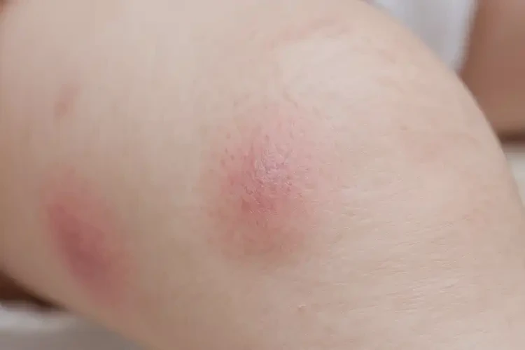 婴幼儿小腿上容易起湿疹可以治好吗(图4)