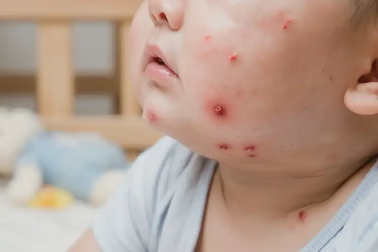 婴幼儿脖子上出湿疹可以治好吗(图4)