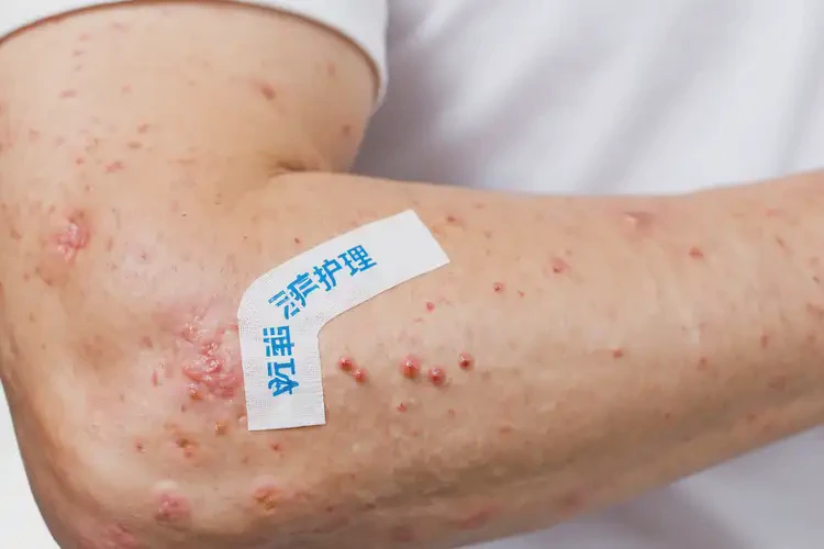 青年人手臂经常起湿疹可以治好吗(图4)