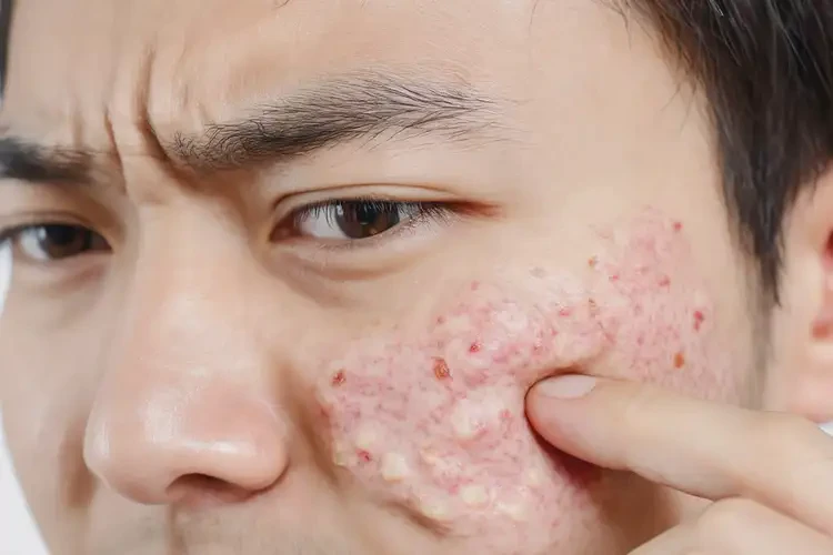 青年人脸上出现湿疹可以治好吗(图3)