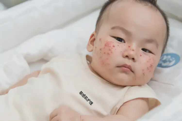 婴幼儿屁股偶尔长湿疹不管它会自己好吗(图4)