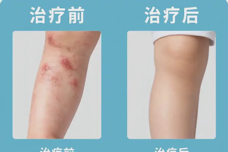 小孩四肢出湿疹可以治好吗(图4)