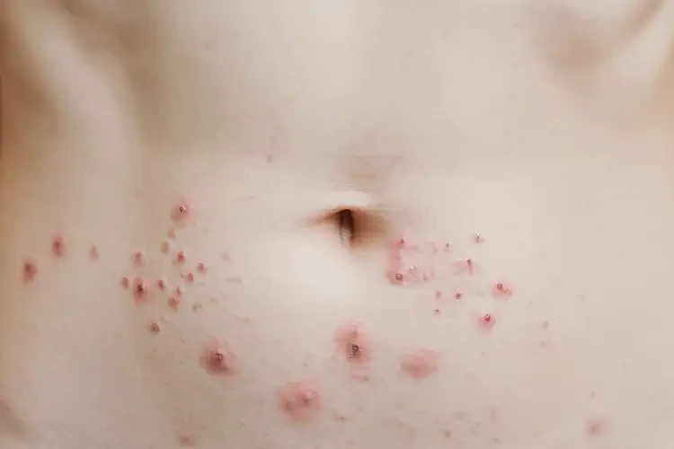 女生肚子上经常起湿疹可以治好吗(图4)