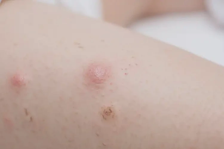婴幼儿大腿出湿疹可以治好吗(图4)