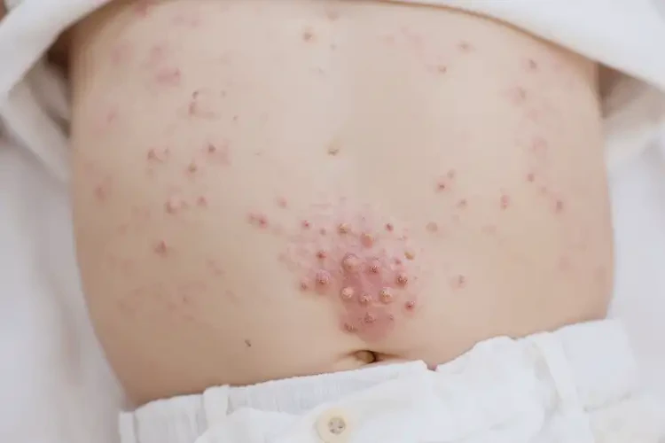 婴幼儿肚子上长湿疹可以治好吗(图4)